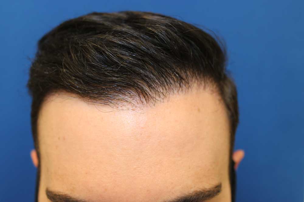 Follicular Unit Extraction Before & After Patient #4438