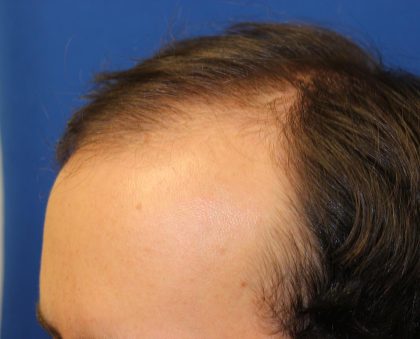 Follicular Unit Extraction Before & After Patient #4378