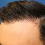 Follicular Unit Extraction Before & After Patient #4438