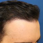 Follicular Unit Extraction Before & After Patient #4438