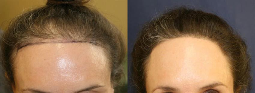 Before and after image of a woman now with full thick head of hair after hair restoration procedure.   California Hair MD Dr. Chaffoo Female Hair Restoration.