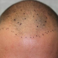 Follicular Unit Extraction Before & After Patient #4804
