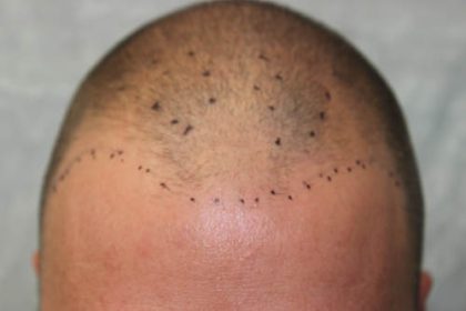 Follicular Unit Extraction Before & After Patient #4804