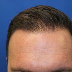 Follicular Unit Extraction Before & After Patient #4804