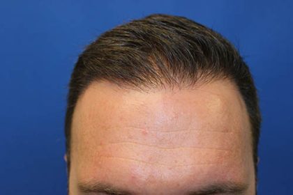 Follicular Unit Extraction Before & After Patient #4804