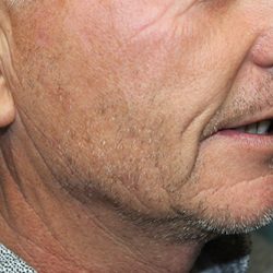 Follicular Unit Extraction Before & After Patient #4750