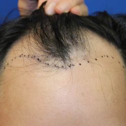Follicular Unit Extraction Before & After Patient #4774