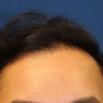 Follicular Unit Extraction Before & After Patient #4774