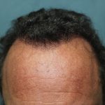Follicular Unit Extraction Before & After Patient #4790