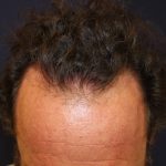 Follicular Unit Extraction Before & After Patient #4790