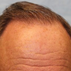 Follicular Unit Extraction Before & After Patient #4783