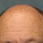 Follicular Unit Extraction Before & After Patient #4783