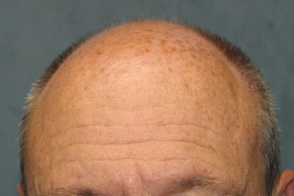 Follicular Unit Extraction Before & After Patient #4783