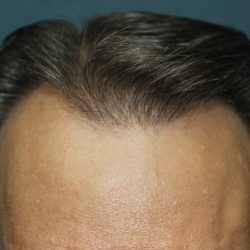 Follicular Unit Extraction Before & After Patient #4767