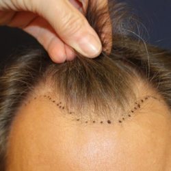 Follicular Unit Extraction Before & After Patient #4767