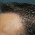 Follicular Unit Extraction Before & After Patient #4767