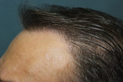Follicular Unit Extraction Before & After Patient #4767