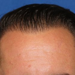 Follicular Unit Extraction Before & After Patient #4797