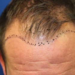 Follicular Unit Extraction Before & After Patient #4797
