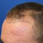 Follicular Unit Extraction Before & After Patient #4797