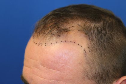 Follicular Unit Extraction Before & After Patient #4797