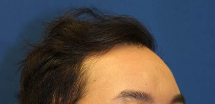 Follicular Unit Extraction Before & After Patient #4774
