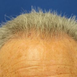 Follicular Unit Extraction Before & After Patient #4884