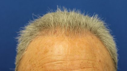 Follicular Unit Extraction Before & After Patient #4884