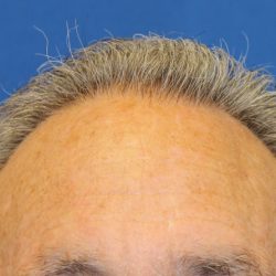 Follicular Unit Extraction Before & After Patient #4884