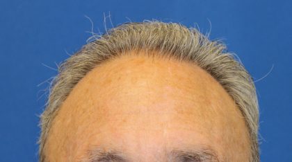 Follicular Unit Extraction Before & After Patient #4884