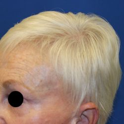 Follicular Unit Extraction Before & After Patient #4883