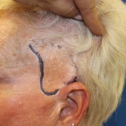 Follicular Unit Extraction Before & After Patient #4883