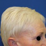 Follicular Unit Extraction Before & After Patient #4883