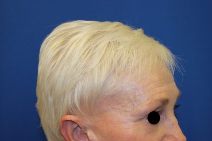Follicular Unit Extraction Before & After Patient #4883