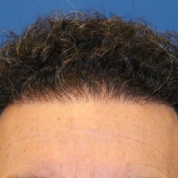Follicular Unit Extraction Before & After Patient #4891