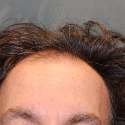 Follicular Unit Extraction Before & After Patient #4891