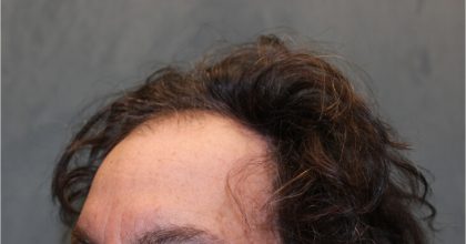 Follicular Unit Extraction Before & After Patient #4891