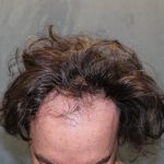 Follicular Unit Extraction Before & After Patient #4891