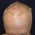 Follicular Unit Extraction Before & After Patient #4921