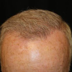 Follicular Unit Extraction Before & After Patient #4921