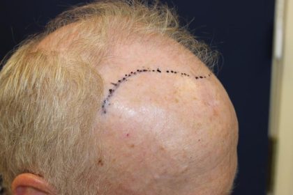 Follicular Unit Extraction Before & After Patient #4921