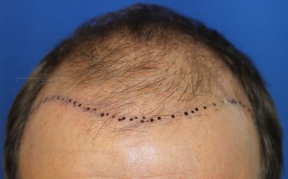 Follicular Unit Extraction Before & After Patient #4922