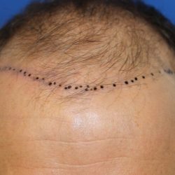 Follicular Unit Extraction Before & After Patient #4922