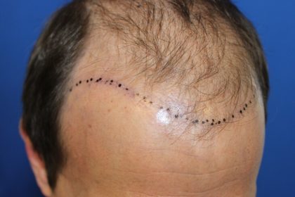Follicular Unit Extraction Before & After Patient #4922