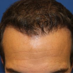 Follicular Unit Extraction Before & After Patient #4922