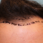 Follicular Unit Extraction Before & After Patient #5039