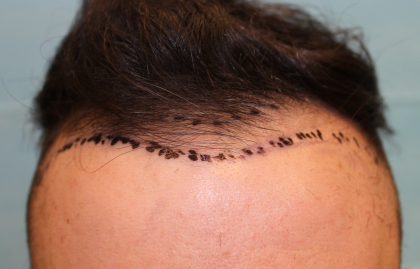 Follicular Unit Extraction Before & After Patient #5039