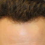 Follicular Unit Extraction Before & After Patient #5046