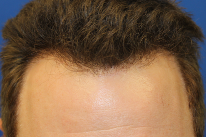 Follicular Unit Extraction Before & After Patient #5046