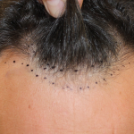 Follicular Unit Extraction Before & After Patient #5053